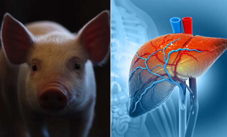 S-a efectuat primul transplant de ficat de la porc la om